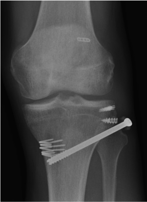 Fibula head bony avulsion ORIF